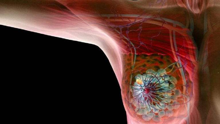 Localisation des Boules de Cancer du Sein : Tout ce que Vous Devez Savoir