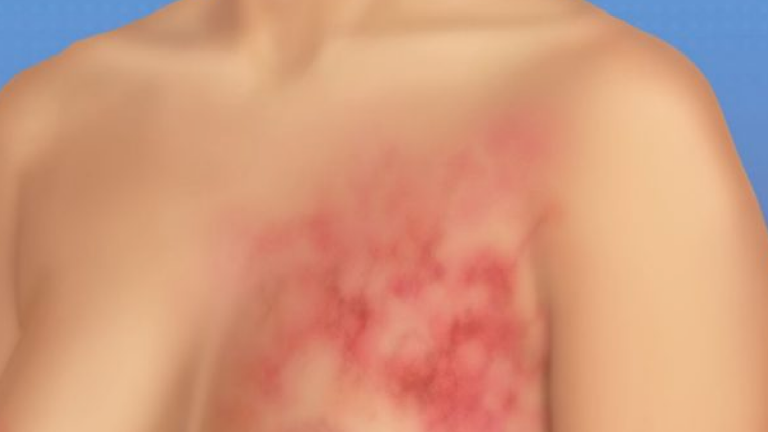 Comment Identifier le Cancer du Sein : Guide Complet